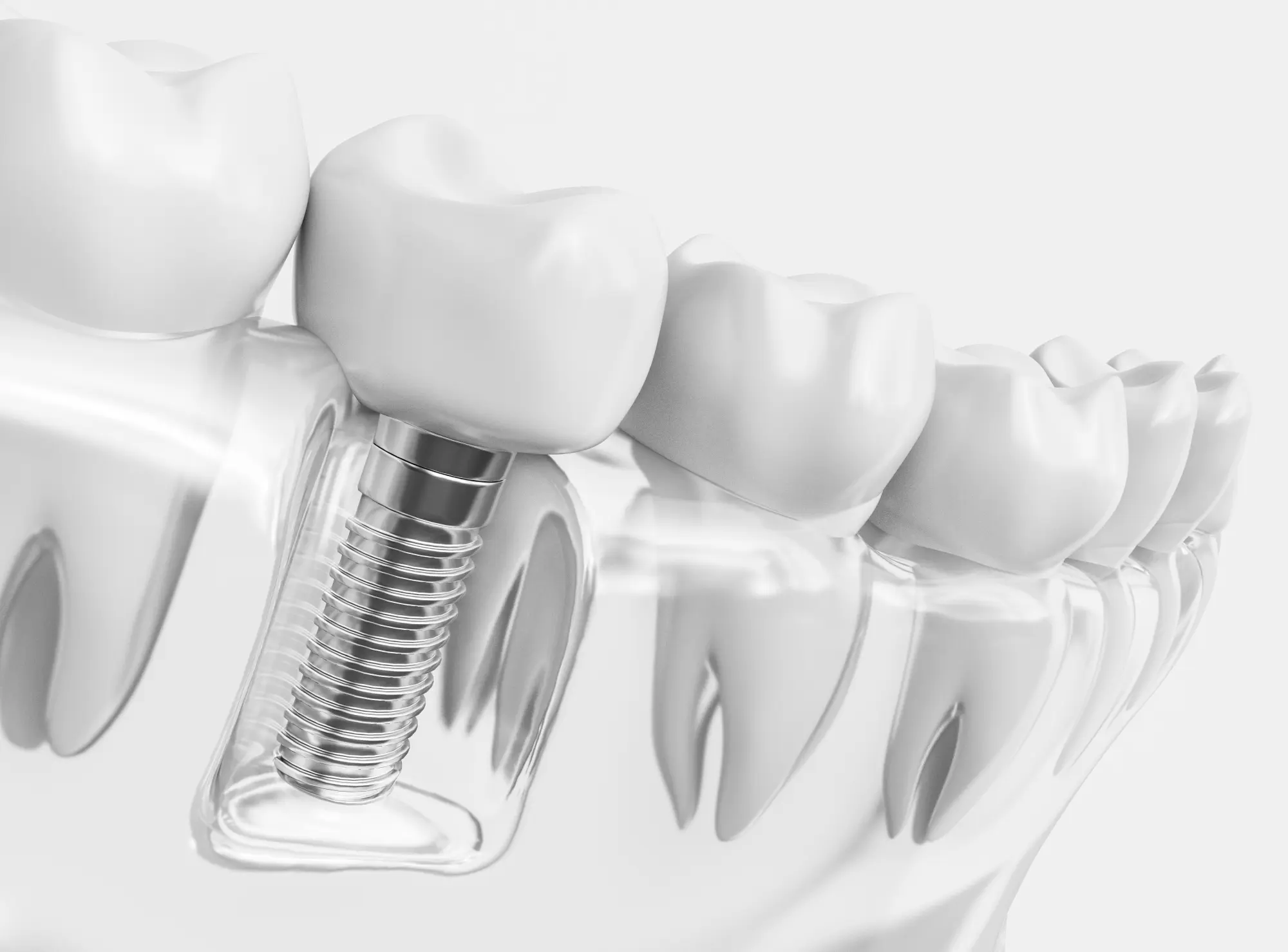 3D Guided Dental Implant Consultation