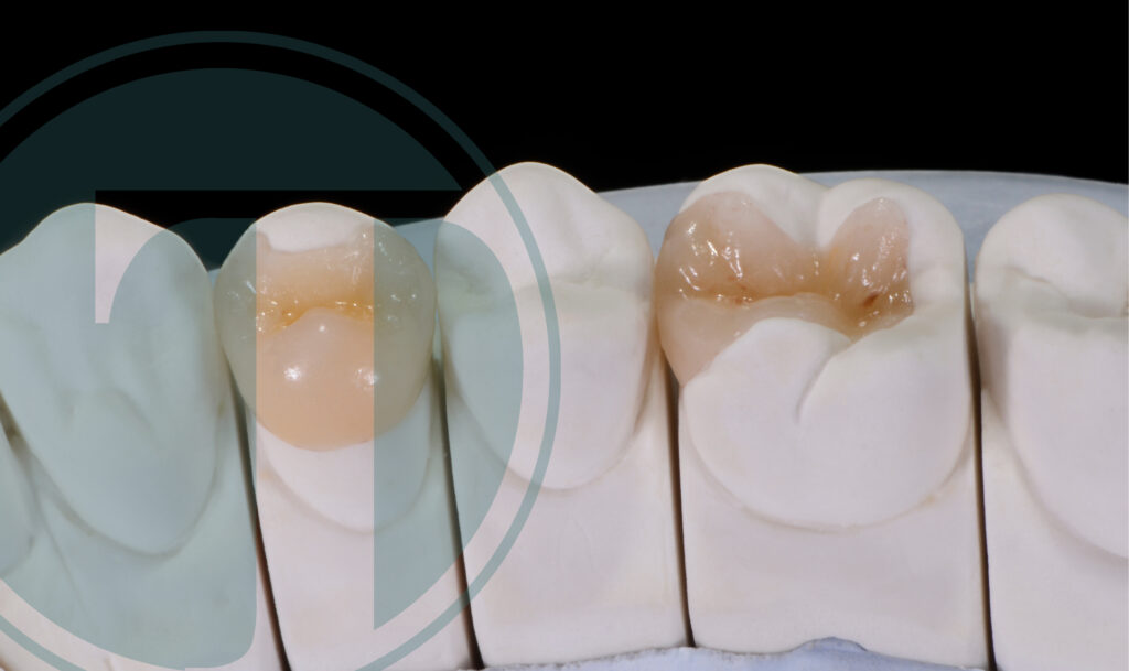 Understanding a dental onlay.